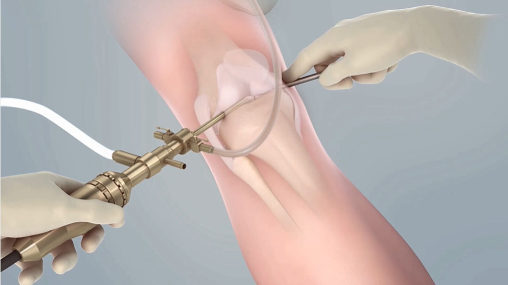 An arthroscopy to survey knee damage and harvest a MACI biopsy.