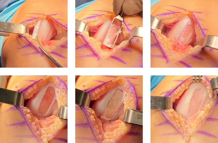 Surgical step-by-step showing MACI implantation into a patient’s knee