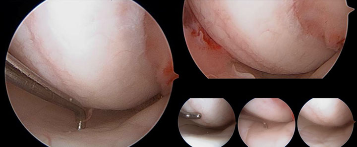 Arthroscopy findings from an 18-year-old patient revealing central grade III chondromalacia about the femoral condyle measuring 15 x 11 mm and corresponding grade II chondromalacia about the central weight-bearing portion of the tibial plateau measuring 12 x 15 mm.