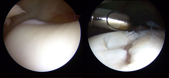 Images from a left knee arthroscopy uncovering a lateral trochlea defect measuring 10 x 12 mm and a patellar facet defect measuring 16 x 18 mm.