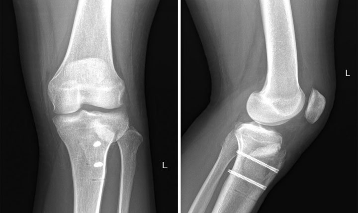 X-ray image of knee treated with MACI with an unloading tibial tubercle osteotomy.