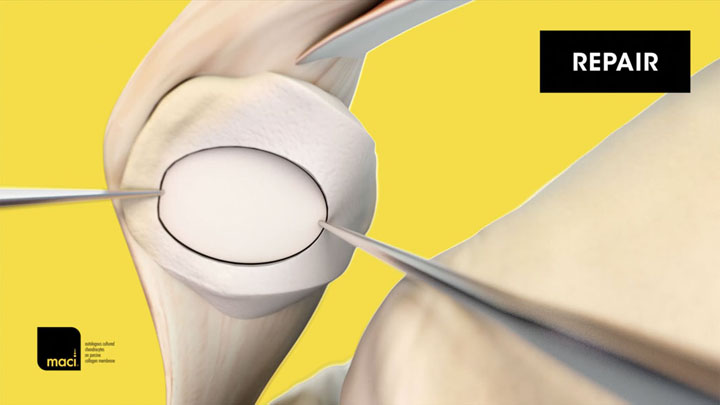 Case Study: Isolated Patella Lesion Repair with Knee Cartilage Repair Surgery
