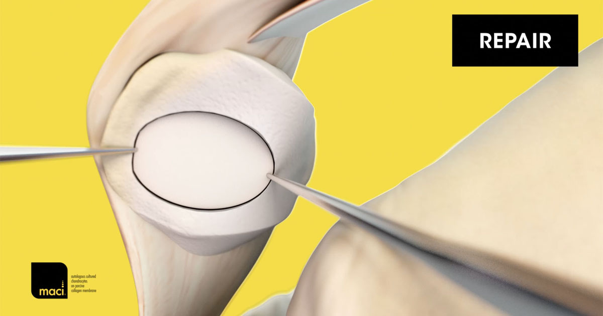 Case Study Isolated Patella Lesion Repair with Knee Cartilage Repair