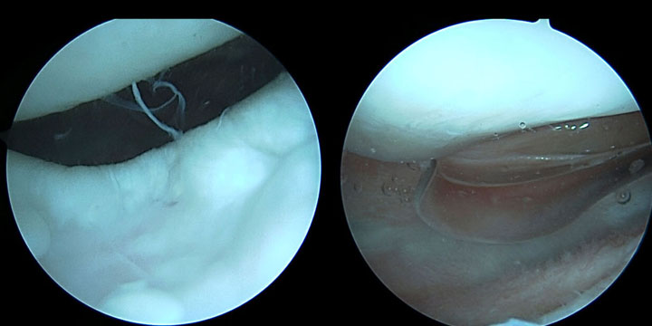 Arthroscopy image shows the removal of loose bodies in a 23-year-old patient’s knee