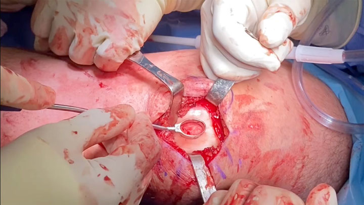 Intraoperative image of patient knee showing MACI implantation onto trochlear defect to repair articular cartilage damage