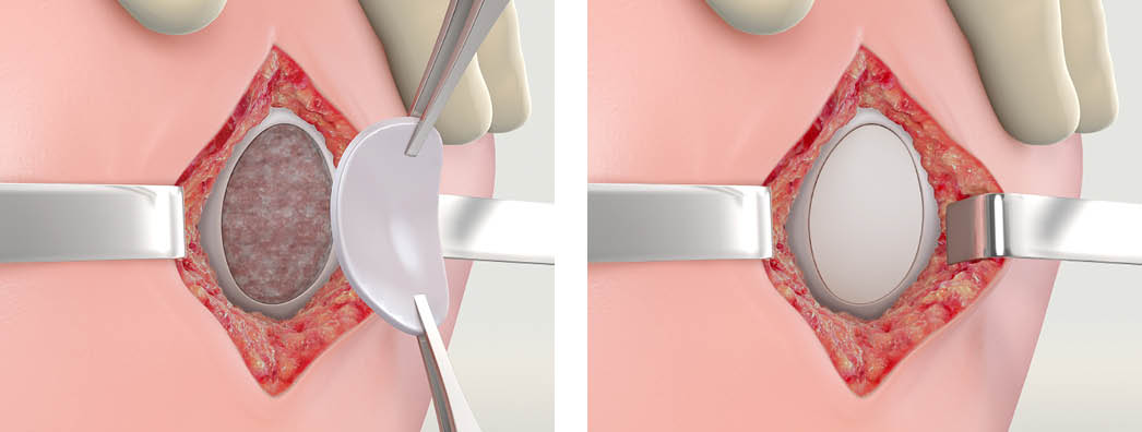Placement of the MACI Implant