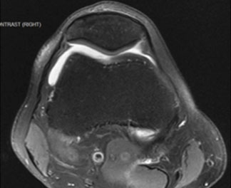 a single 9 cm2 cartilage lesion with boney involvement in the left medial femoral condyle