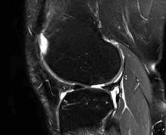 a 2.2 cm2 cartilage lesion in the right lateral femoral condyle