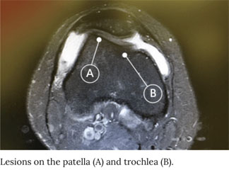 a 9 cm2 trochlea defect and a 4 cm2 patella defect, both in the right knee